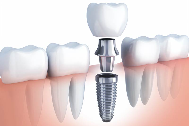 Dental Implants in Philadelphia